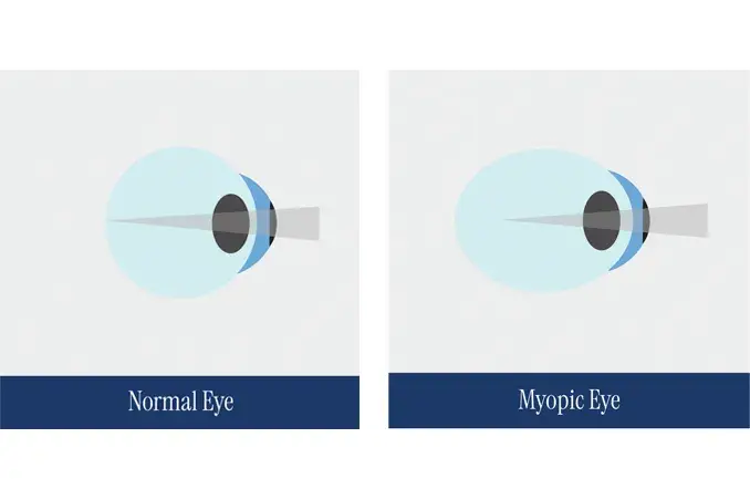 Normal eye versus myopia eye